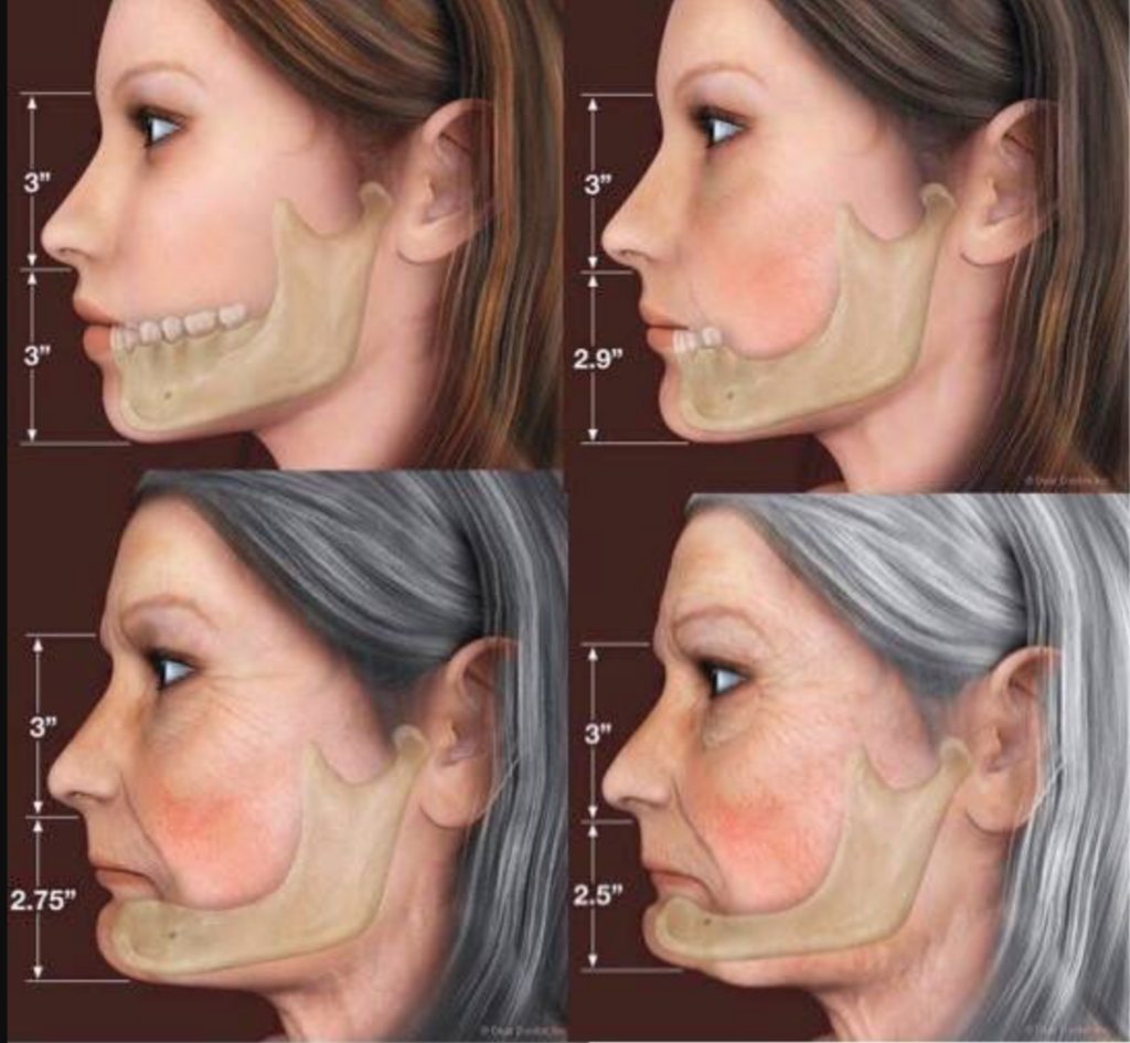 Bone loss and aging face 