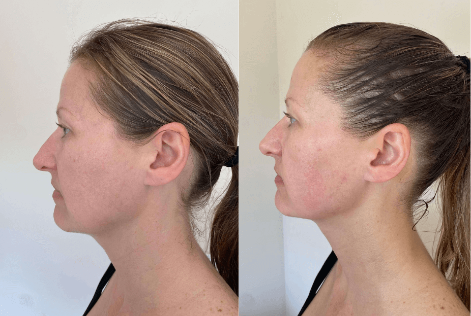 Sculpting Inner Mouth Buccal Face Massage before and after