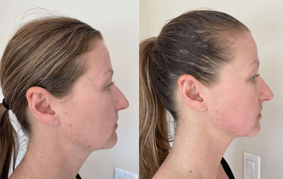 Inner Mouth Buccal Face Massage Results
